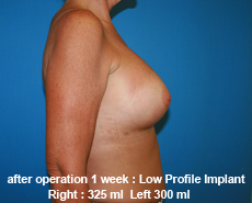 plastic-surgery-breast-augmentation